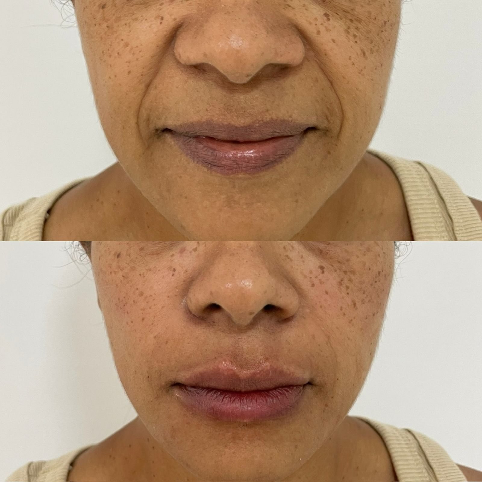 Antes e depois do bigode chinês