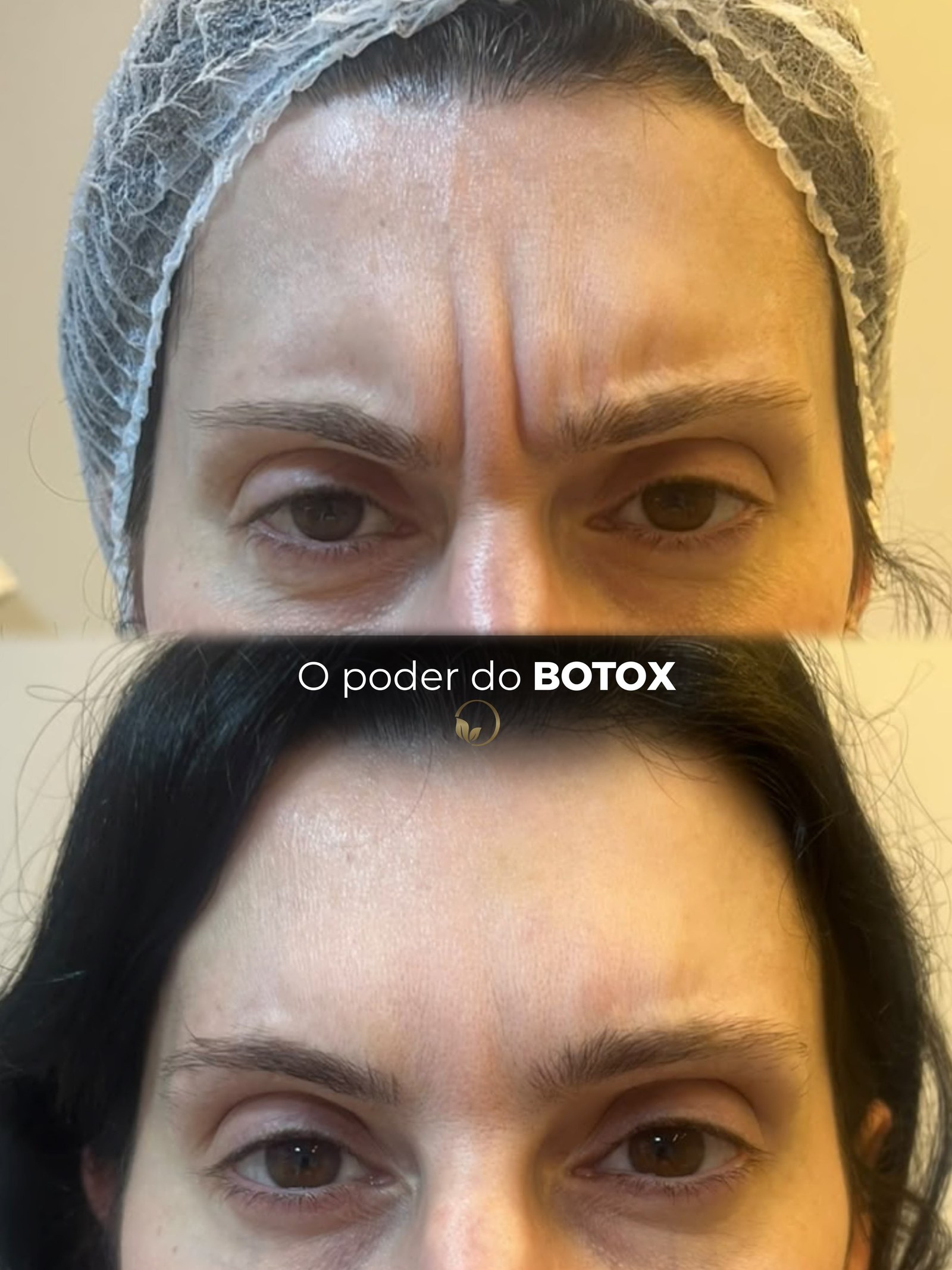 Antes e depois de botox na testa