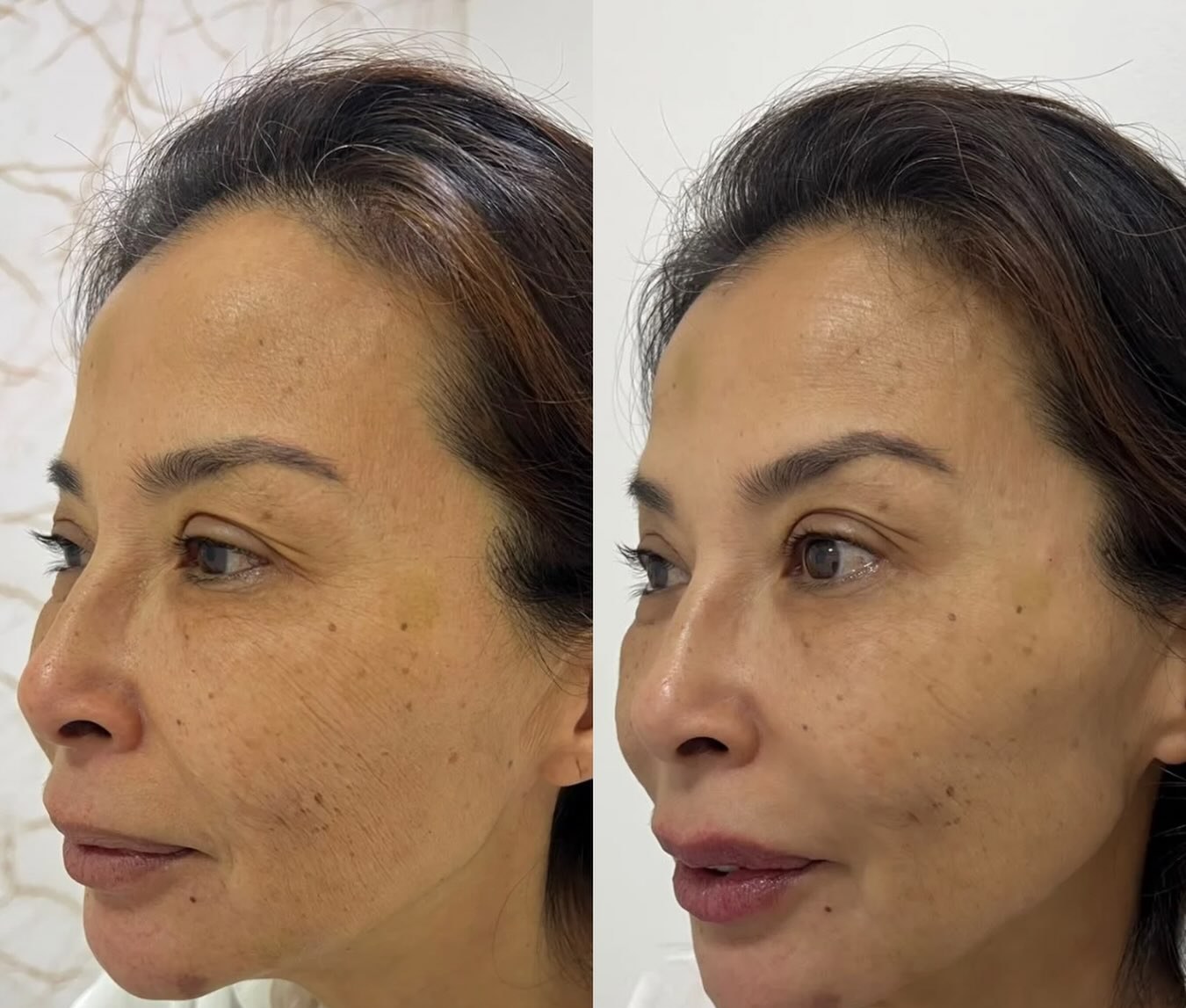 Antes e depois de harmonização facial