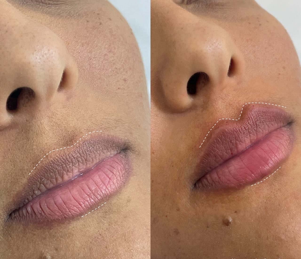 Antes e depois de preenchimento labial