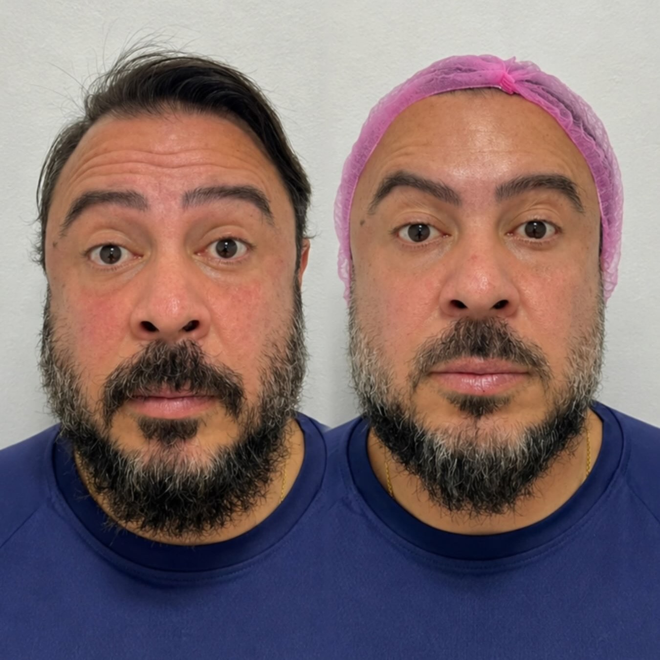 Antes e depois masculino