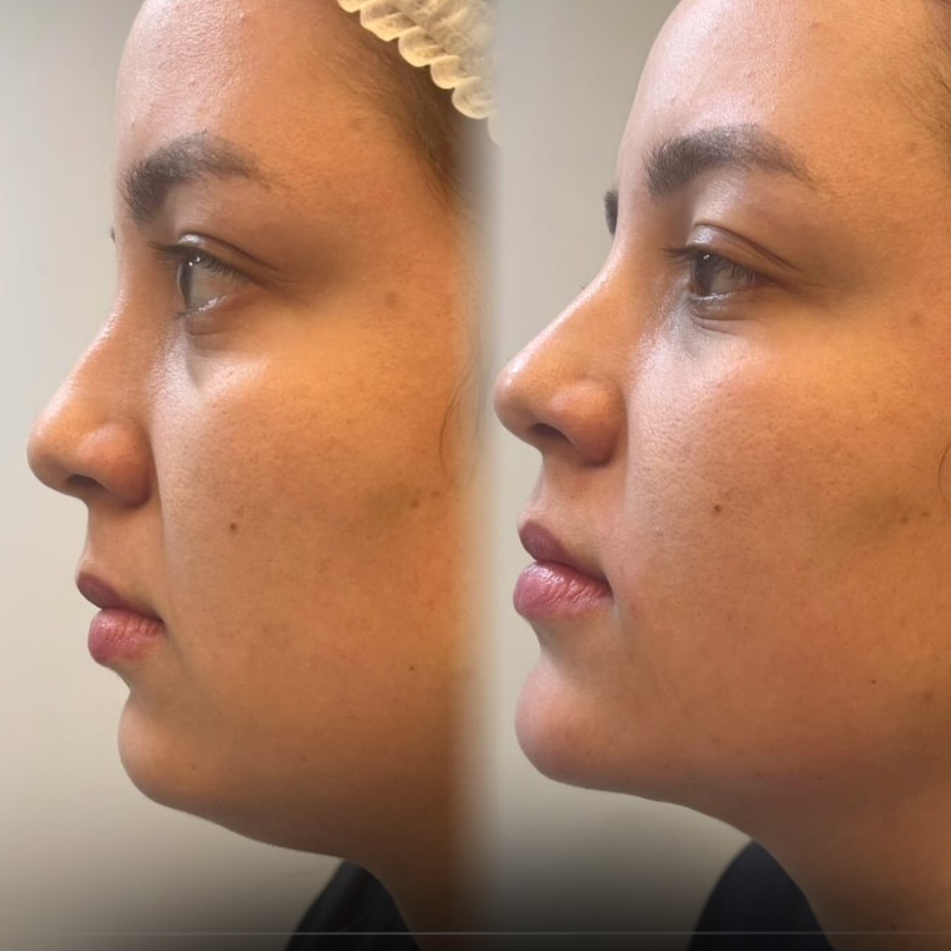 Antes e depois de harmonização de perfil