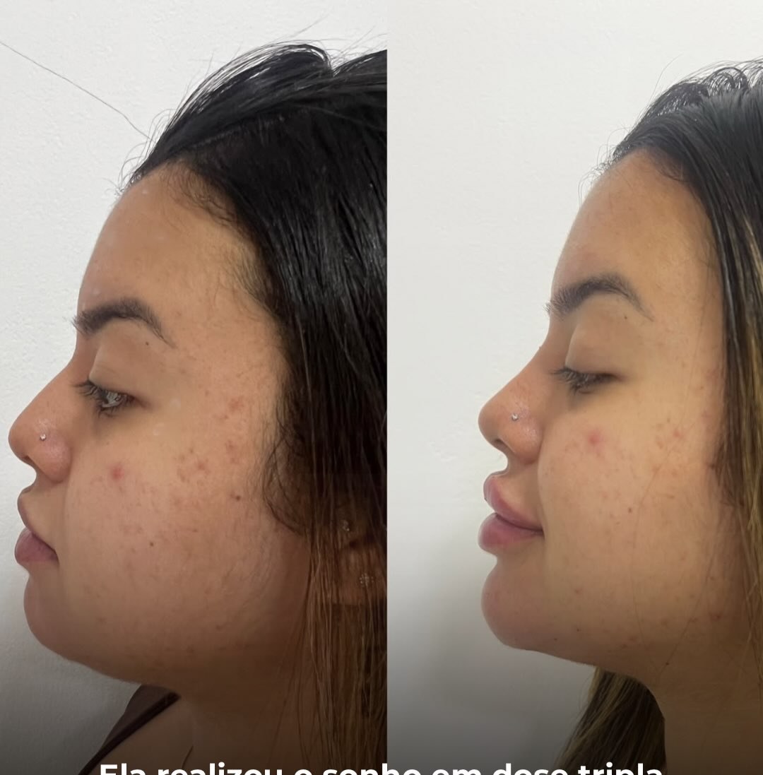 Antes e depois de perfil